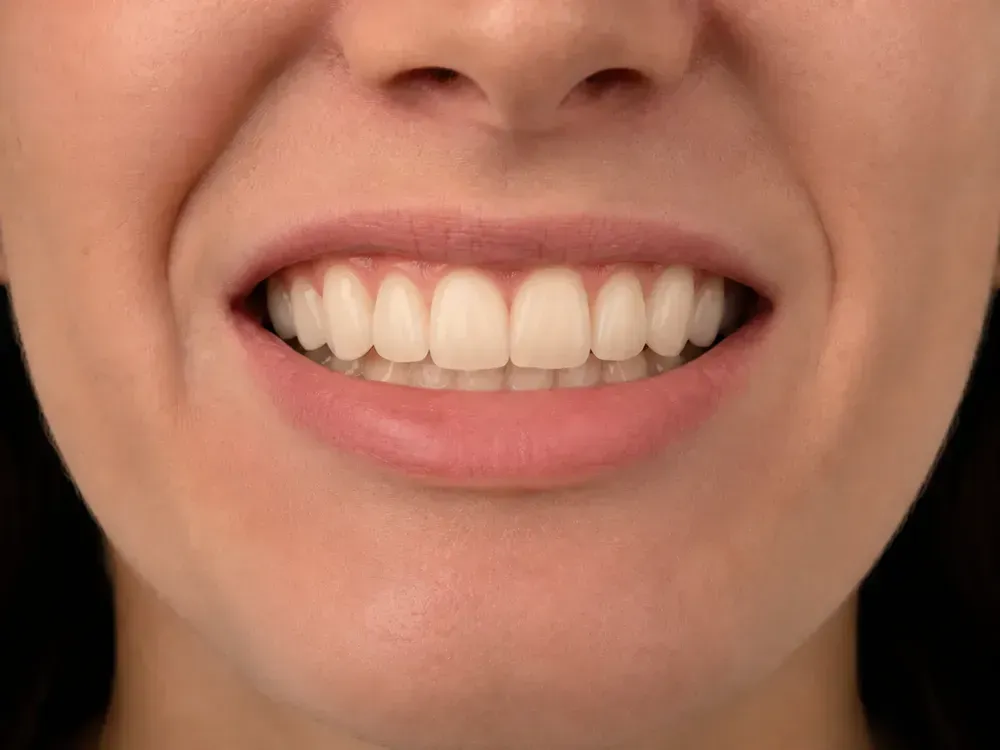 After smile correction with straighter front teeth